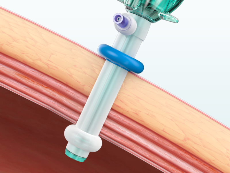 The perfect combination of unique designed balloon and fixator can accurately make the puncture device firmly on abdominal wall.
